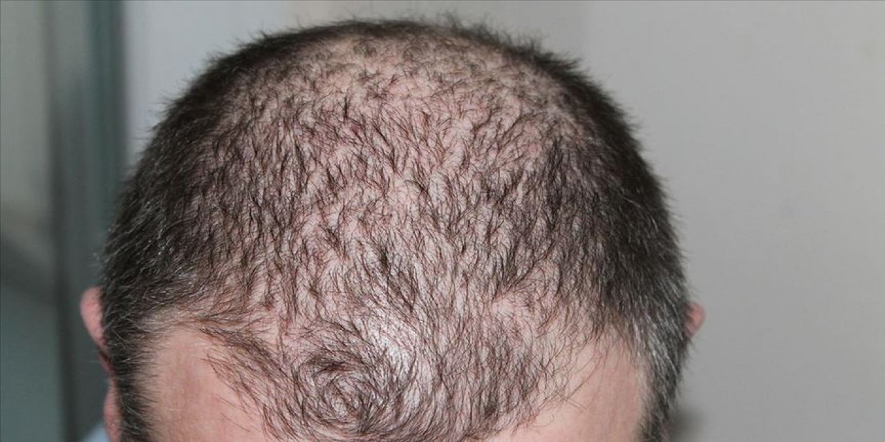 Uzmanlar Saç Dökülmesi ve Nedenleri Hakkında Bilgi Verdi! Ciddi Hastalıkların Belirtisi Olabilir