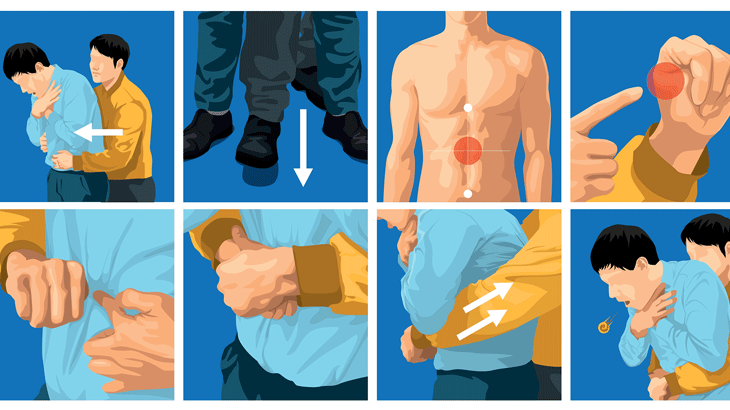 Heimlich Manevrası Nedir, Nasıl Yapılır? Hayat Kurtaran İlkyardım Yöntemi Hakkında Her Şey