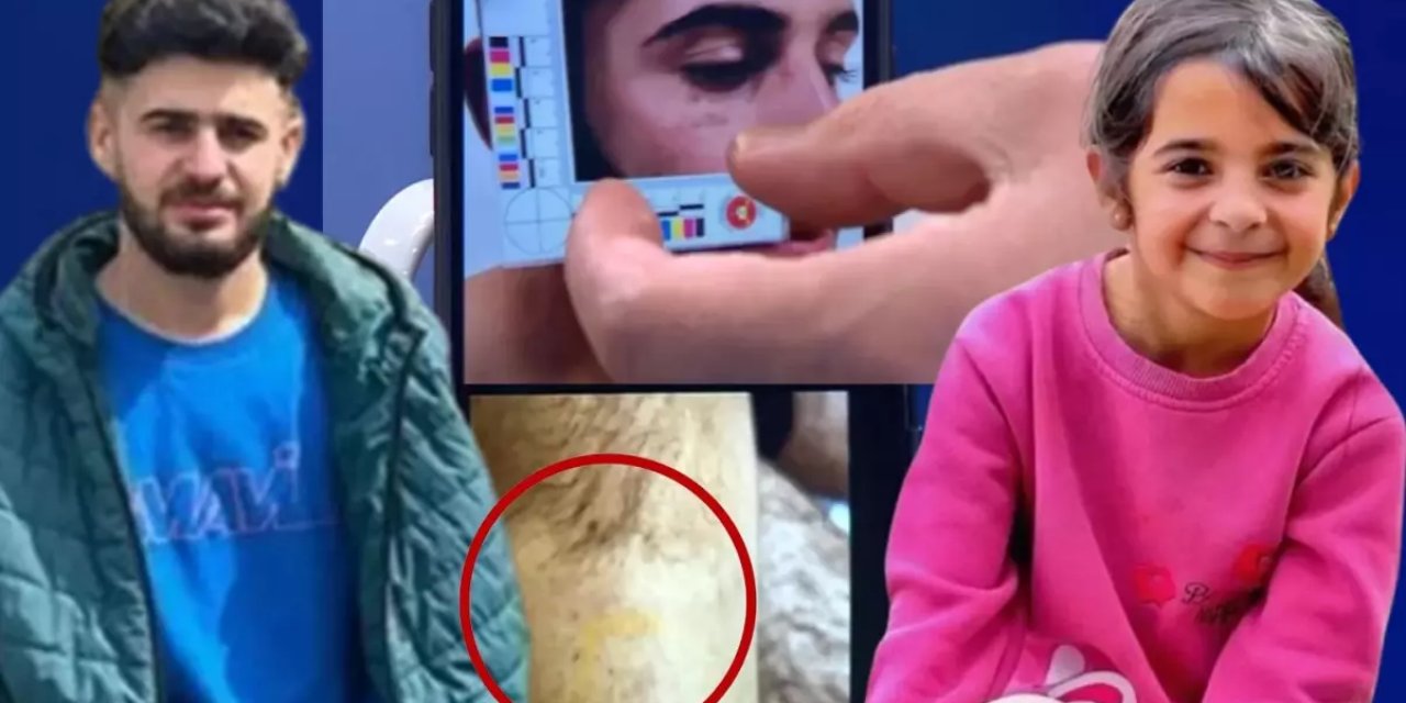 Narin'in ağabeyi Enes Güran'ın kolundaki ısırık izinin görüntüleri ortaya çıktı