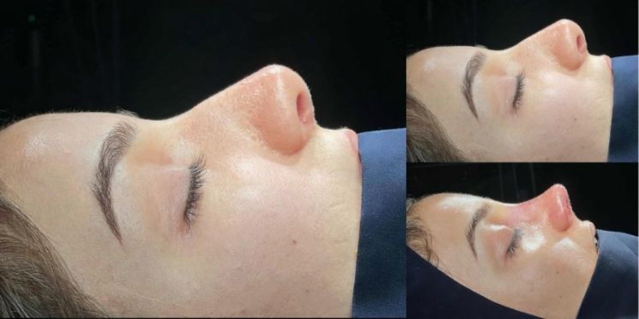 Cizre’de Sağlık Alanında Tarihi Adım: İlk Revizyon Rinoplasti Başarıyla Yapıldı