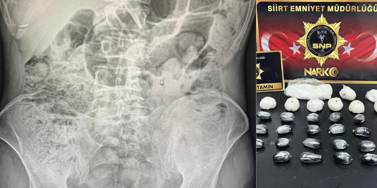 Siirt'te 4 kişinin midesinden kilolarca uyuşturucu çıkarıldı