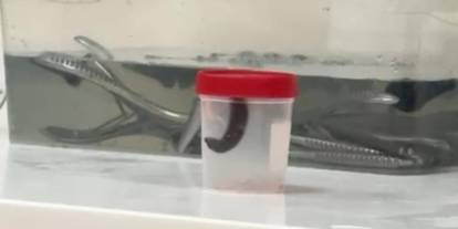 Siirt te 6 yaşındaki çocuğun boğazından sülük çıktı