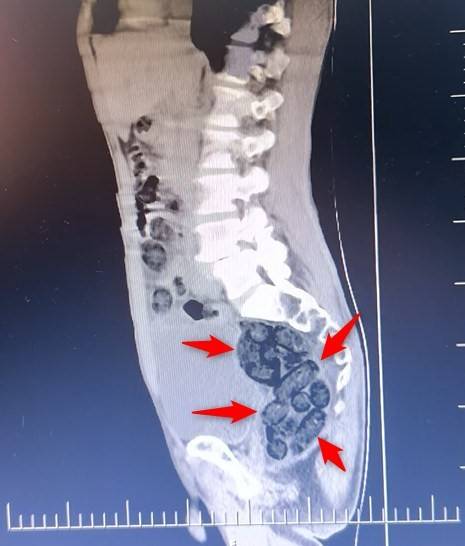 Yabancı Uyruklu Bir Şahsın Midesinden 64 Parça Uyuşturucu Çıktı